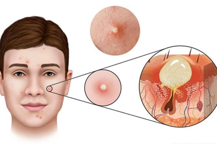 Tại sao nên sử dụng kem trị mụn sưng viêm? 
