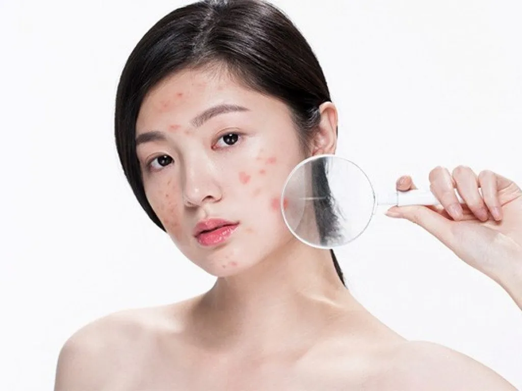 Môi trường vi khuẩn dễ gây mụn