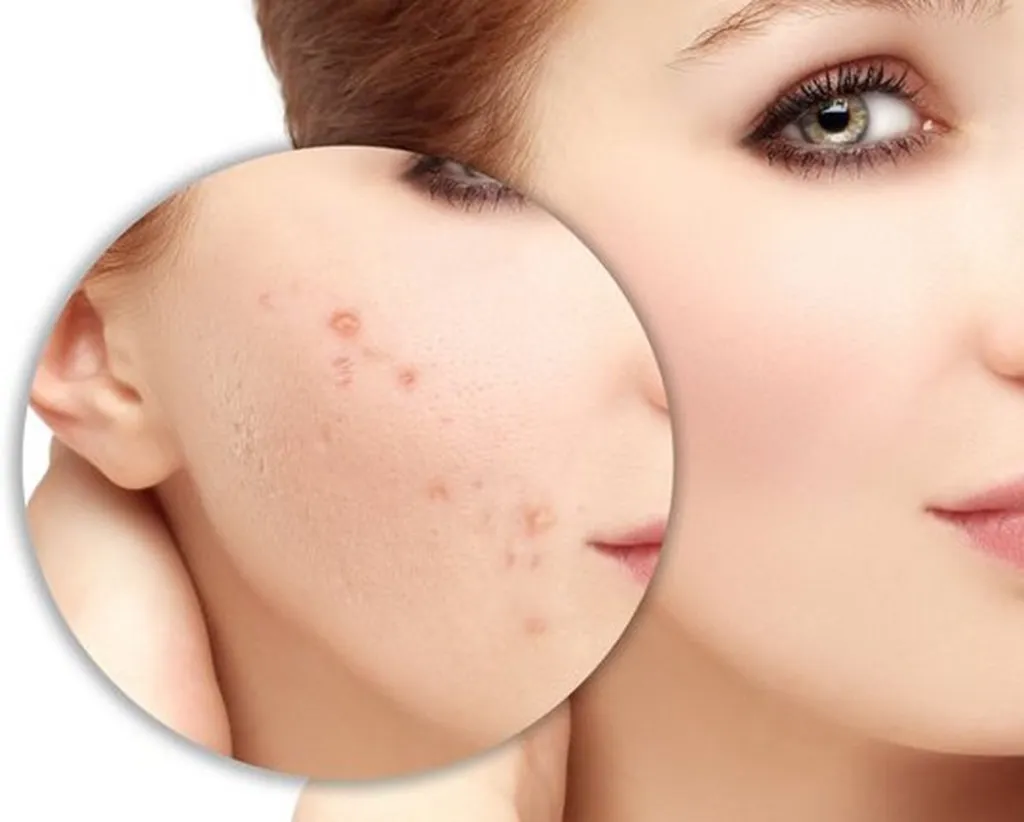 Kiên trì sử dụng kem trị mụn tuổi dậy thì để thấy hiệu quả