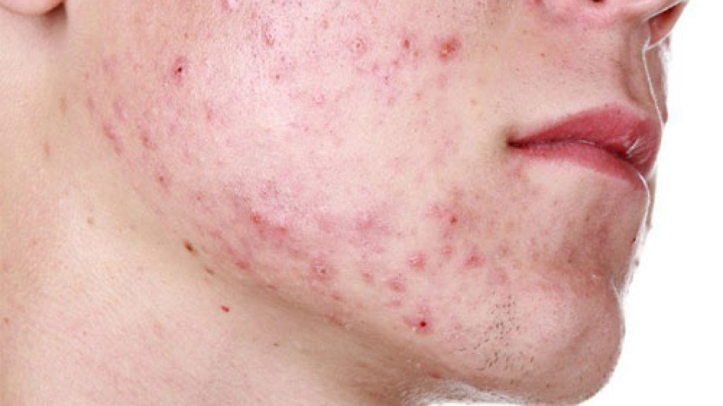 Các loại mụn thường thấy ở nam giới