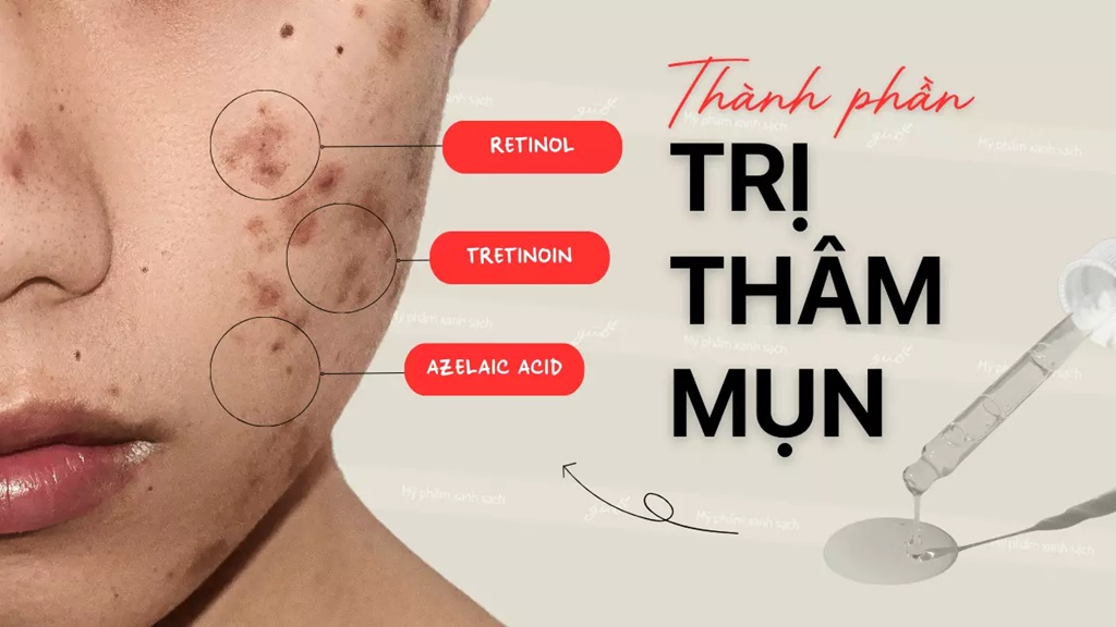 Cách chọn kem trị thâm mụn cho nam