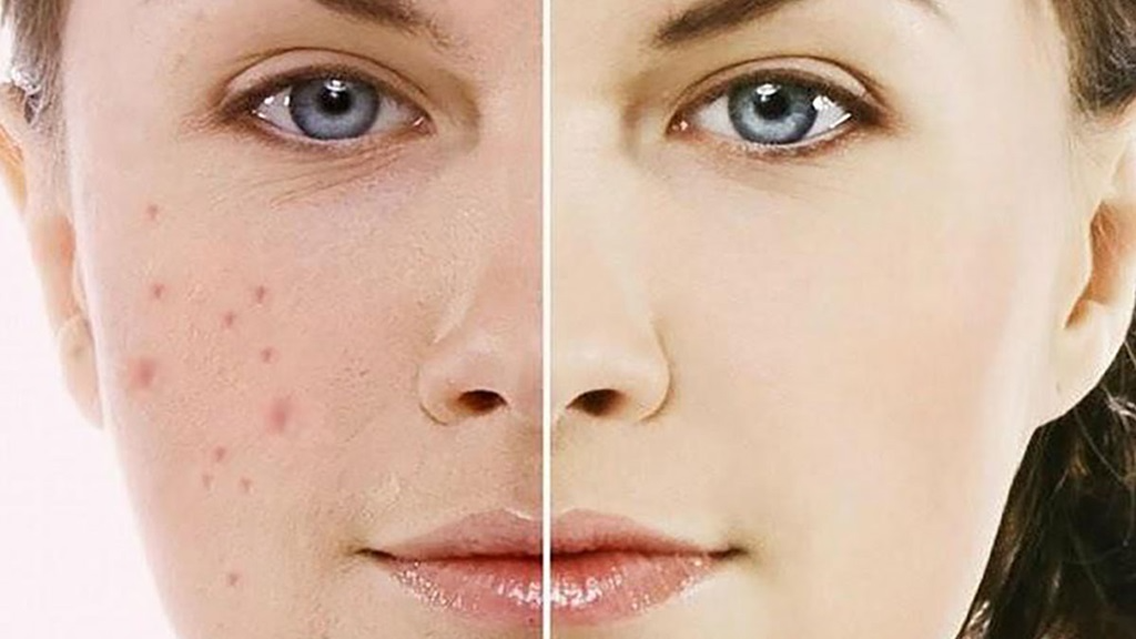 Tiêu chí lựa chọn kem trị thâm mụn