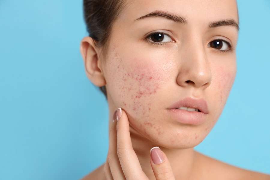 L-cystine có công dụng hỗ trợ điều trị mụn trứng cá