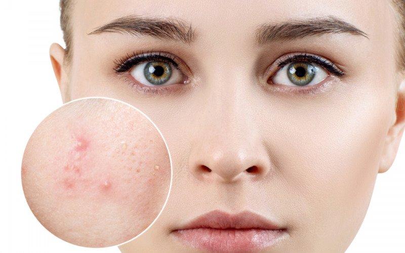L-Cystine giúp điều trị tình trạng mụn trên da