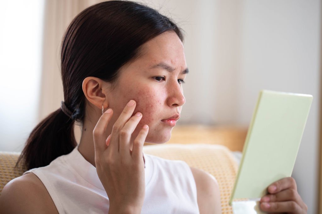 Tìm hiểu chi tiết về tình trạng mụn ẩn ở má