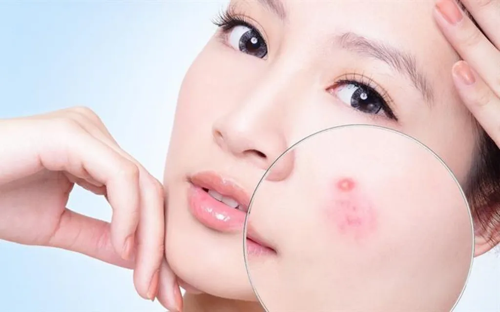Bị viêm nhiễm cũng là lý do bị mụn viêm