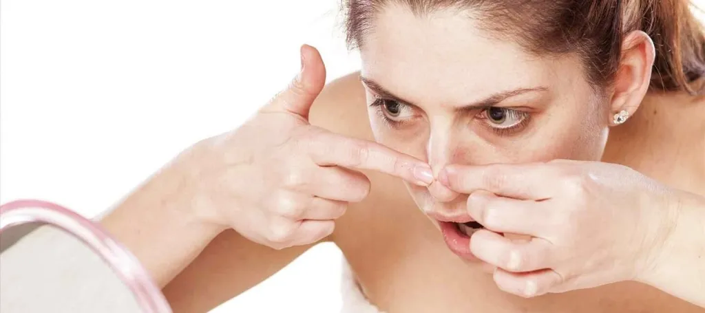 Đảm bảo nặn mụn đúng cách