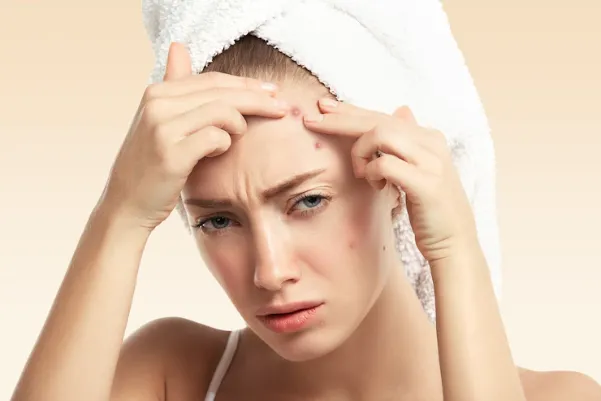 Nặn mụn là nguyên nhân chính gây ra thâm mụn