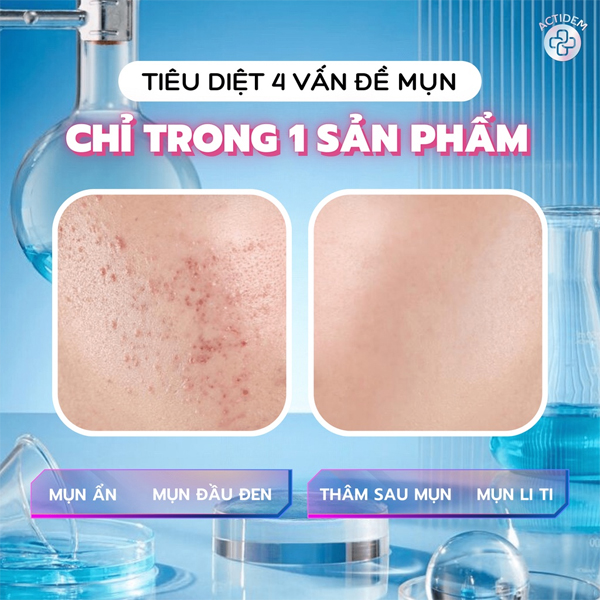 Tiêu diệt 4 vấn đề mụn chỉ trong 1 sản phẩm