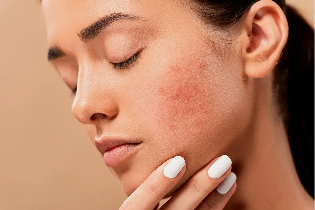 Mụn ẩn có tự hết được không