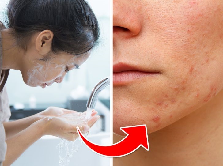 Chăm sóc da mặt không đúng cách có thể gây ra tình trạng mụn ẩn đỏ nặng hơn