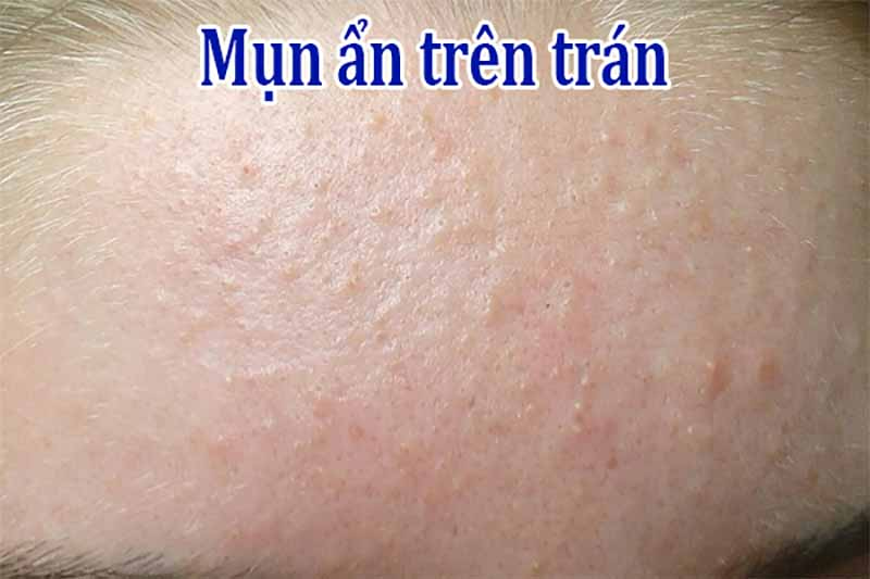 Nguyên nhân phổ biến hình thành mụn ẩn