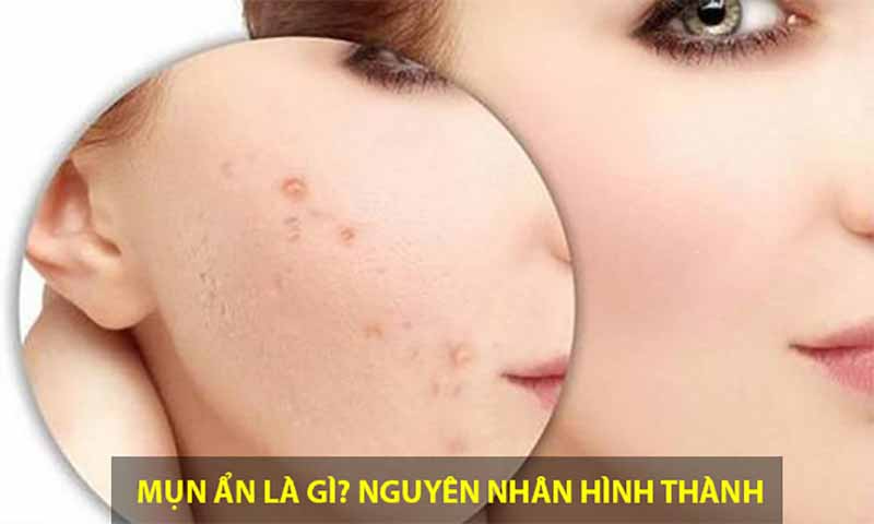 Mụn ẩn xuất hiện ở đâu