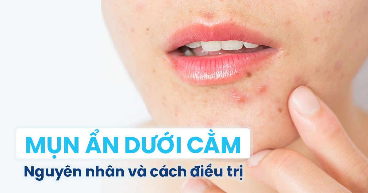 Tìm hiểu về tình trạng xuất hiện mụn ẩn ở cằm