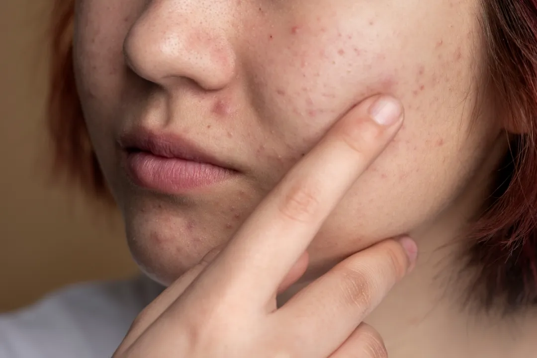 Mụn ẩn sưng đỏ là gì