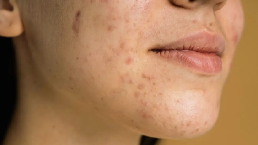 Nguyên nhân khiến mụn ẩn sưng đỏ