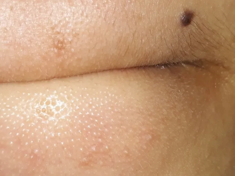 mụn cám ở cằm