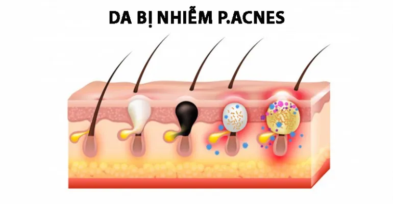 mụn cám ở cằm