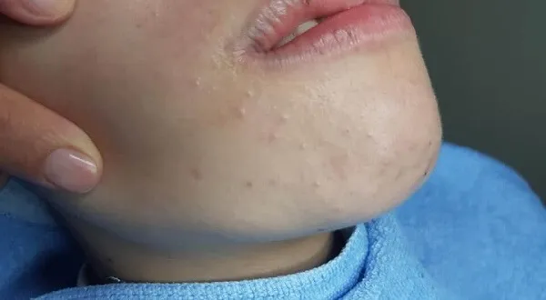 mụn cám ở cằm