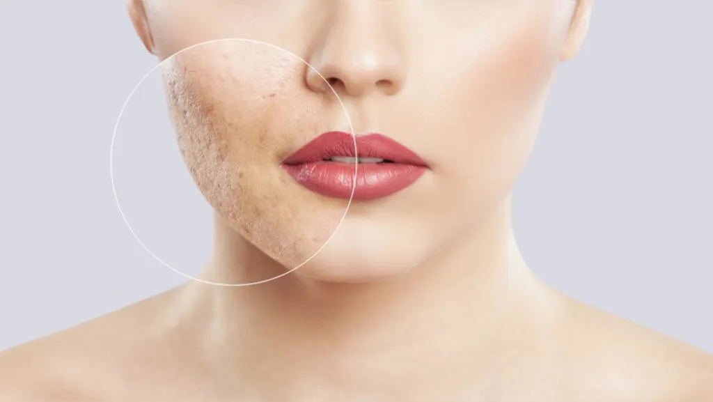 Mụn cám ở mặt