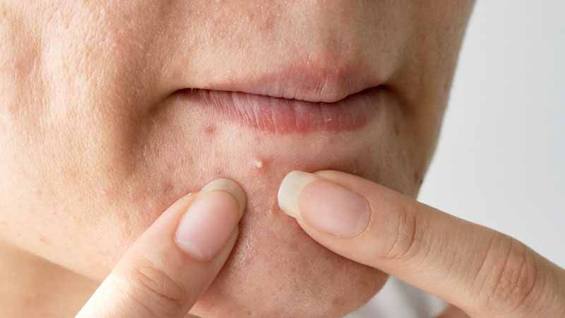Thông tin về mụn đầu trắng là gì?