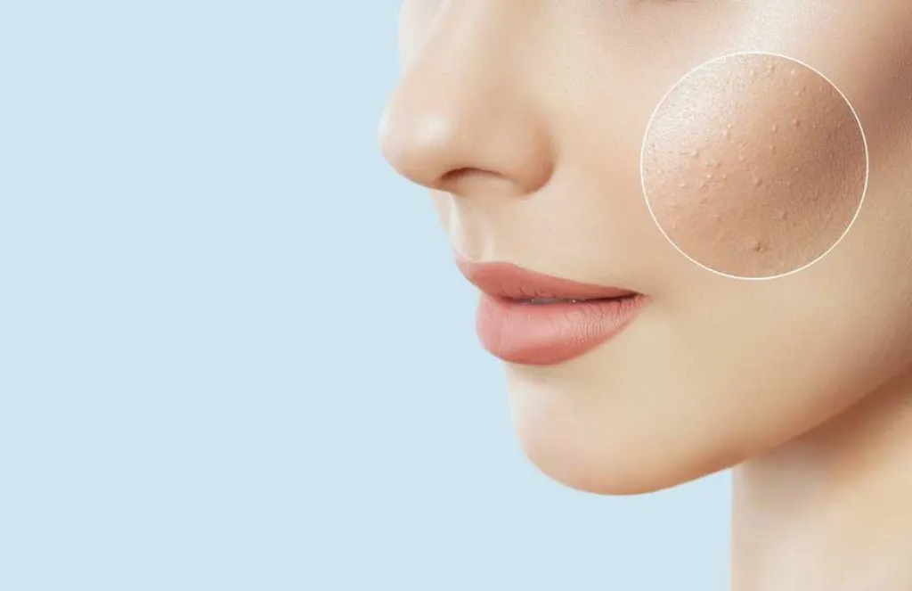 Các loại mụn li ti thường gặp