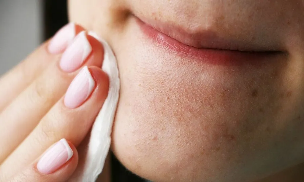 Mụn li ti khiến da mặt khó chịu