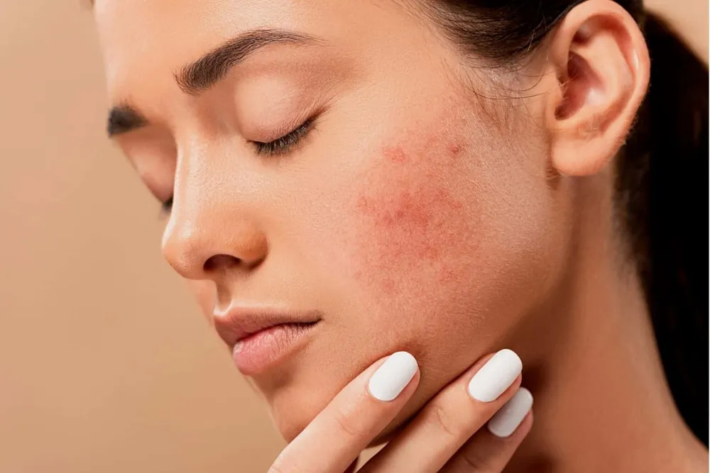 Nguyên nhân bị mụn nội tiết