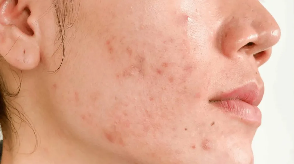 Nặn mụn tiết tố sai cách làm tăng nguy cơ sẹo