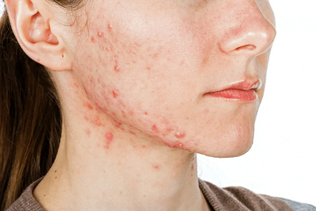 Mụn nội tiết tố là gì