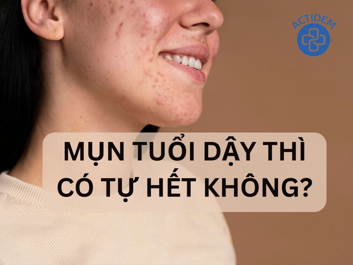 Giải đáp thắc mắc: Mụn tuổi dậy thì có tự hết không?