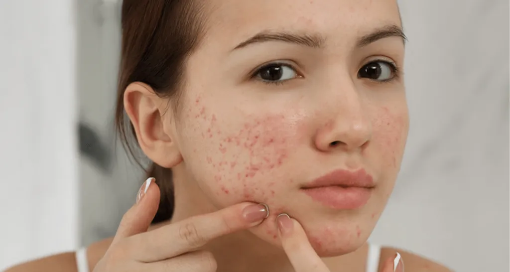 Thường xuyên sờ tay lên mặt là tác nhân khiến tình trạng mụn trở nên phức tạp hơn