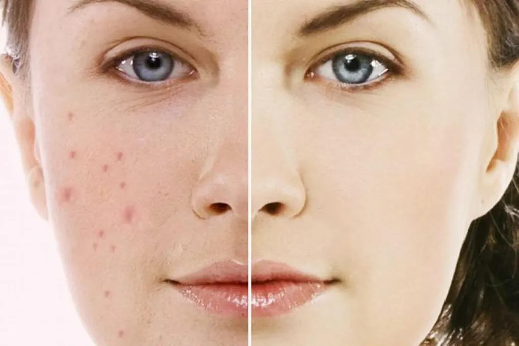 Thường xuyên sờ tay lên mặt là tác nhân khiến tình trạng mụn trở nên phức tạp hơn