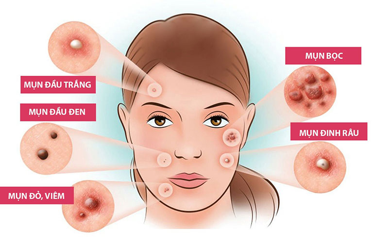 Một số loại mụn dậy thì thường gặp nhất hiện nay.
