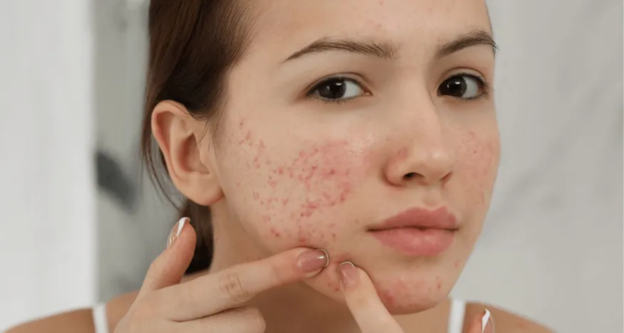 Tác hại và hậu quả của mụn viêm nếu không điều trị đúng cách