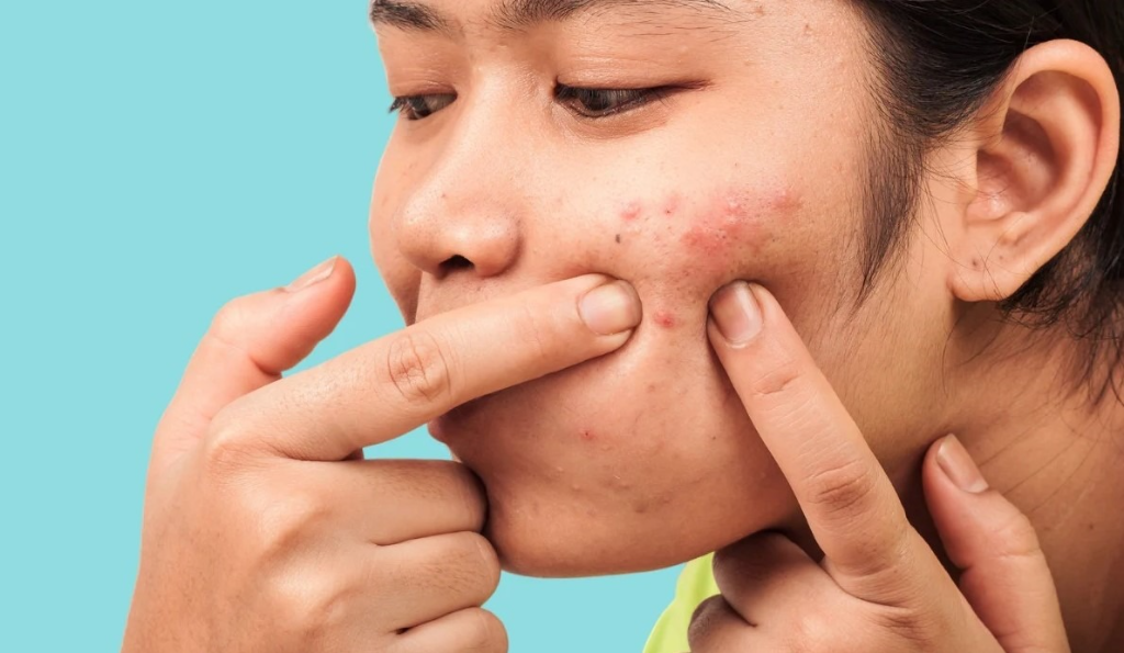 Các yếu tố ảnh hưởng đến tình trạng mụn viêm