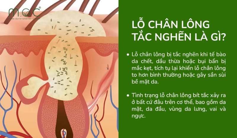 Tắc nghẽn lỗ chân lông là gì? Nguồn: @mocvietnam