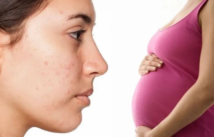 Mang thai là một trong những nguyên nhân gây nên mụn viêm ở cằm