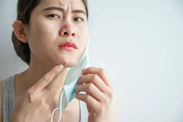 Đeo khẩu trang là một trong những nguyên nhân phổ biến gây mụn viêm ở cằm