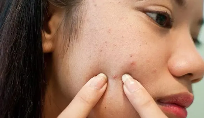 Nặn mụn có thể khiến mụn bị vỡ và viêm nhiễm nặng hơn
