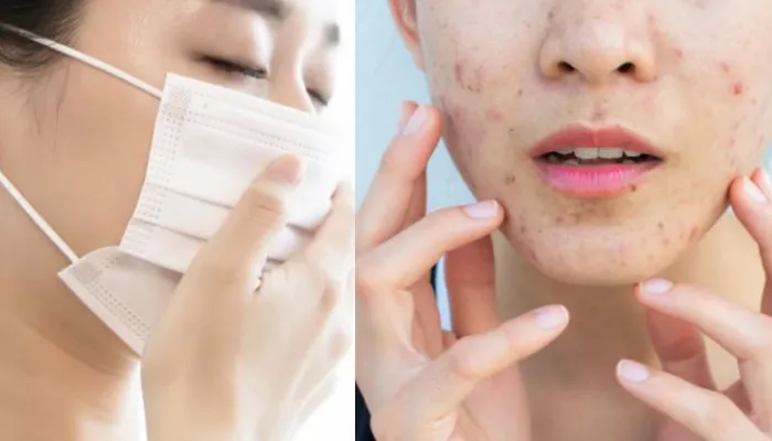 Đeo khẩu trang có thể gây mụn viêm ở má