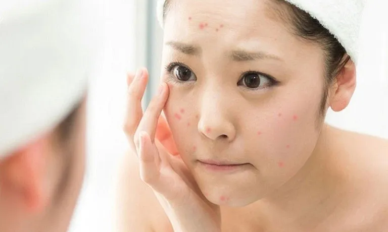 Vệ sinh da mặt không đúng cách là nguyên nhân gây nên mụn viêm ở mũi.