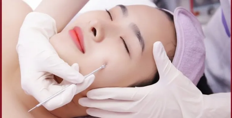 Nặn mụn là một phương pháp điều trị mụn phổ biến