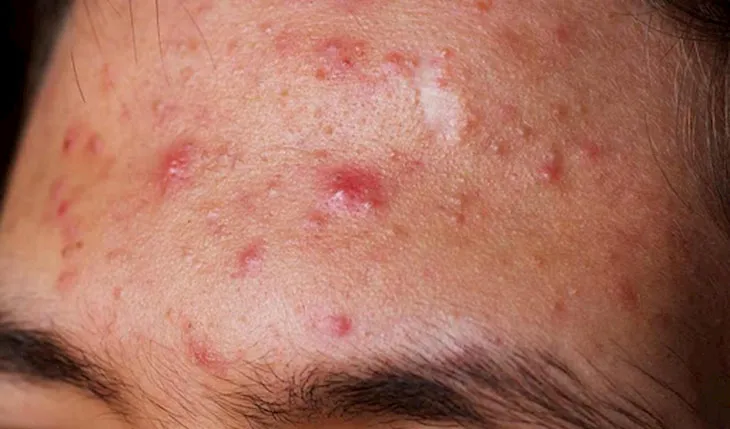 Mụn viêm ở trán mẩn đỏ