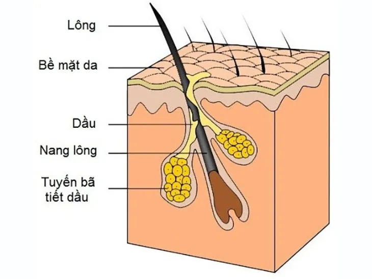 Bã nhờn là nguyên nhân gây nên mụn viêm sưng đỏ