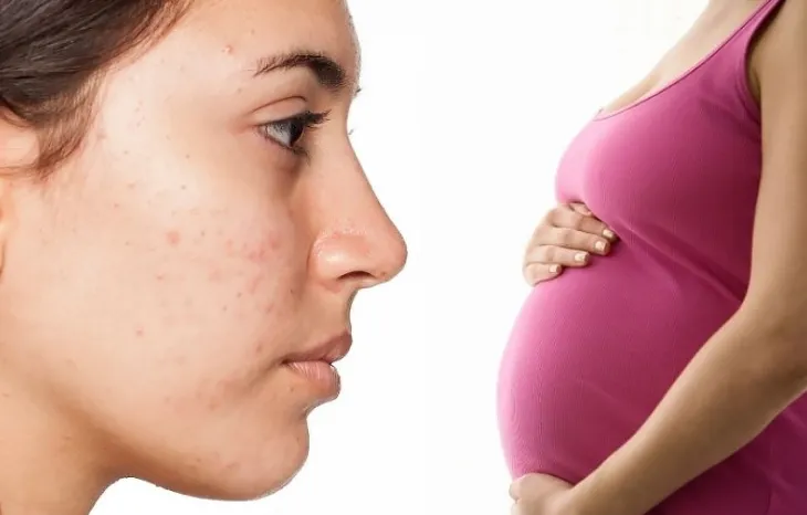 Phụ nữ mang thai nội tiết tố progesterone tăng cao cũng có thể gây mụn