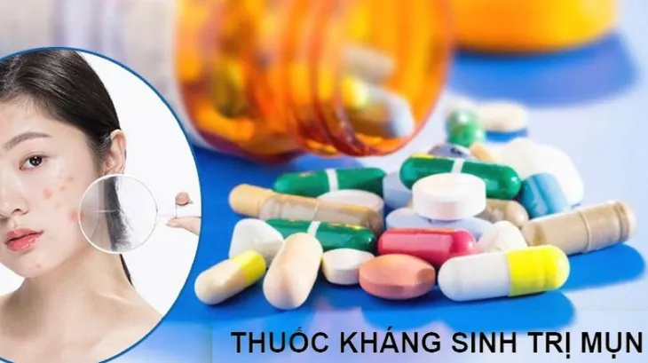 Thuốc kháng sinh là phương pháp điều trị mụn viêm sưng đỏ phổ biến nhất