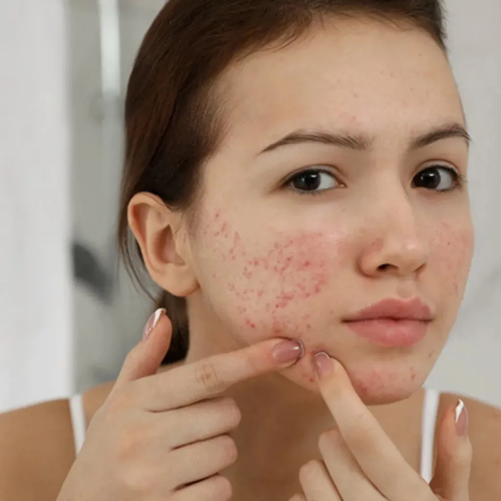 Vùng mụn tổn thương quá mức