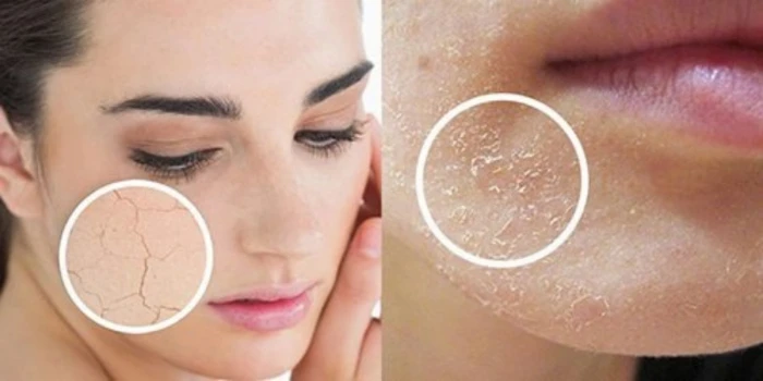 Da bị thiếu ẩm cũng là nguyên nhân gây nặn mụn bị thâm