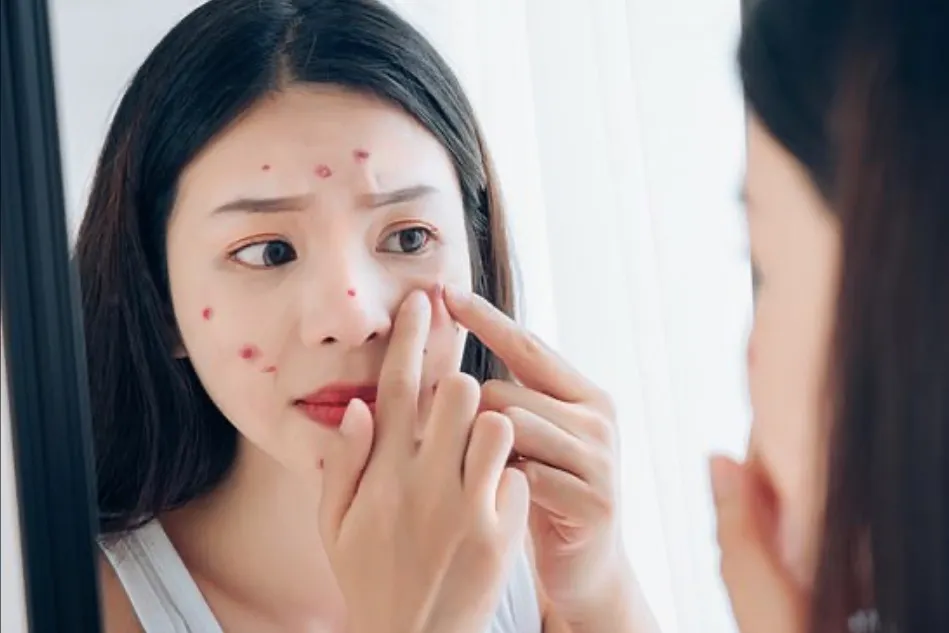Khó tránh được “cám dỗ” nặn mụn khi soi gương